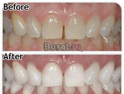 Голливудская улыбка за копейки Москва