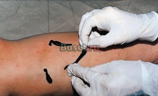 Услуги врача - гирудотерапевта Москва