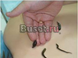 Гирудотерапия лечение пиявками на дому Петербург Санкт-Петербург