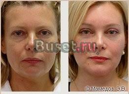 Скиндалженс Безоперационная подтяжкамышц лица Санкт-Петербург