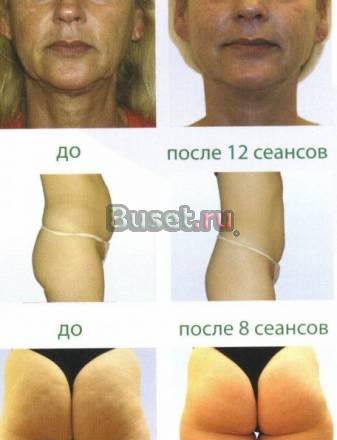 Мезотерапия лица и тела. Недорого Москва